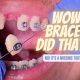 0 min 80x80 - آیا با داشتن دندان مصنوعی می توان بریس دریافت کرد؟