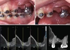 بیس فسفونات ها و خطر استئومیلیت فک بالا در طول درمان دندانپزشکی