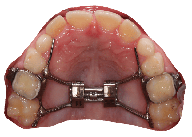 چه کسی می تواند یک کاندید برای گسترش پالاتال باشد؟