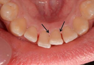 مراحل گردش کار اصلاحی الاینرهای شفاف