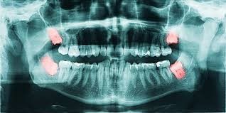 دندان عقل نهفته چیست؟