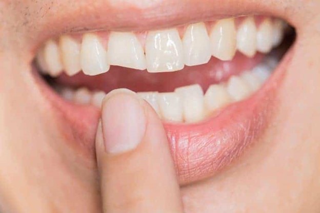 متخصص ارتودنسی چگونه به جویدن ناخن و بریس کمک می کند؟