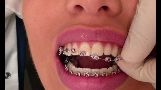 برداشتن بریس ها چقدر طول می کشد؟