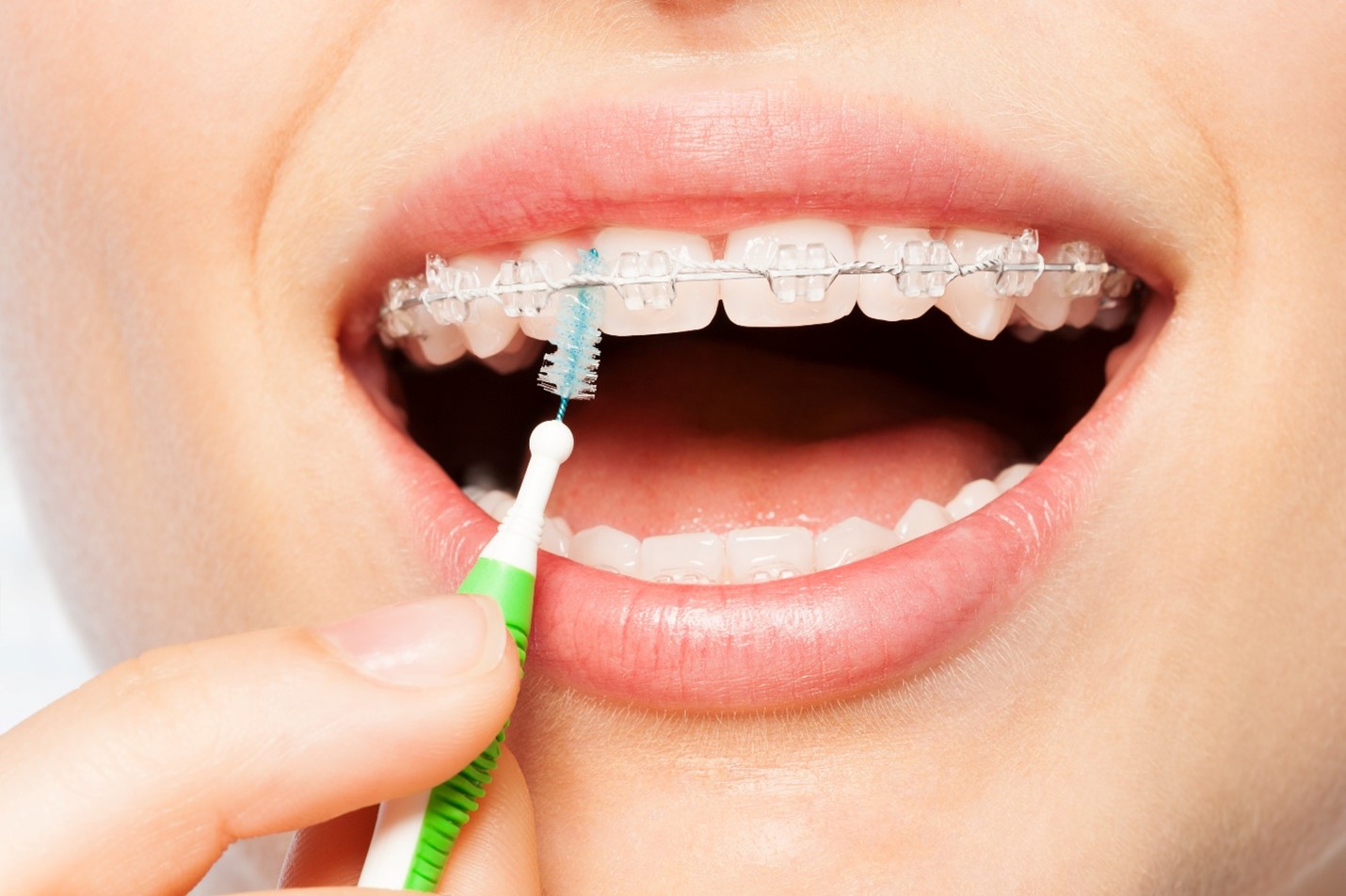 اگر با بریس ها دچار پوسیدگی شوید چه؟