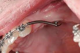استراتژی های اصلاح جای خالی دندان های از دست رفته در طول درمان ارتودنسی