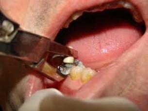 آیا بند شل دندان مولر یک مورد اورژانسی است؟