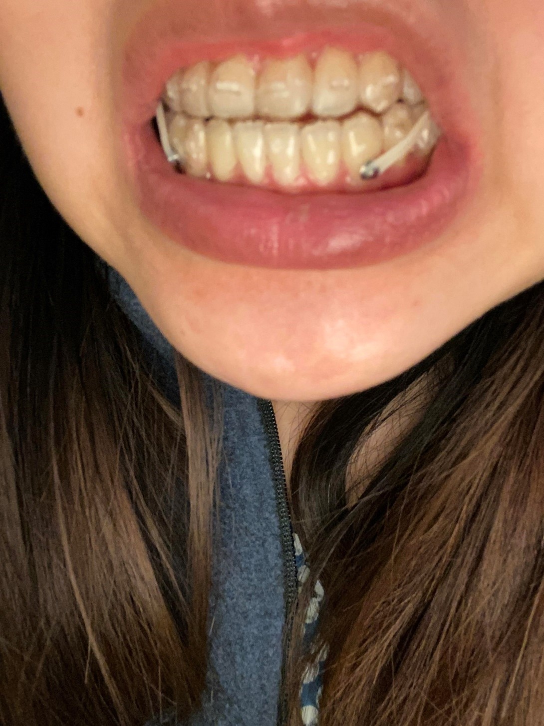 از رابر بندهای مخصوص بریس هایی استفاده کنید که متخصص ارتودنسی ارائه داده است.