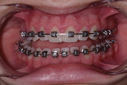 Picture1 - آیا قرار دادن براکت ارتودنسی روی دندان های کوچک امکان پذیر است؟