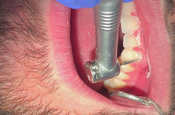 نحوه برداشتن چسب بریس ها: راهنمای گام به گام