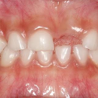 خطرات افتادن زود هنگام دندان های شیری چیست؟